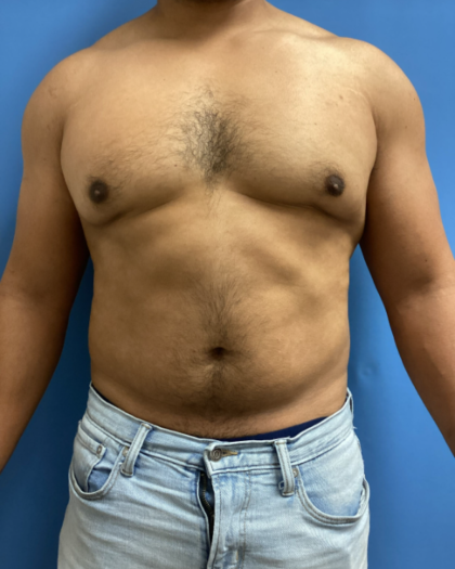 Liposuction Before & After Patient #17076