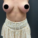 Breast Augmentation with Lift Before & After Patient #17073