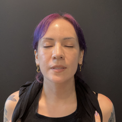 CO2 Laser Before & After Patient #17075