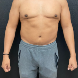Liposuction Before & After Patient #17076