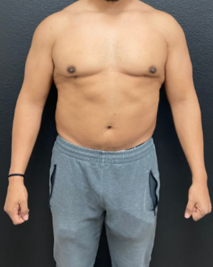Liposuction Before & After Patient #17076
