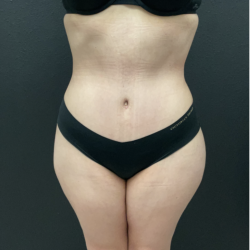 Mommy Makeover Before & After Patient #17079