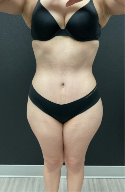 Mommy Makeover Before & After Patient #17079