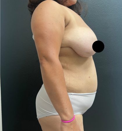 Breast Augmentation with Lift Before & After Patient #17073