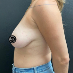 Breast Reduction Before & After Patient #17074