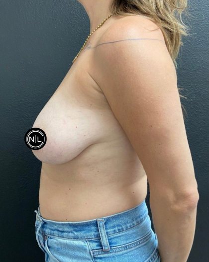 Breast Reduction Before & After Patient #17074