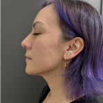 CO2 Laser Before & After Patient #17075