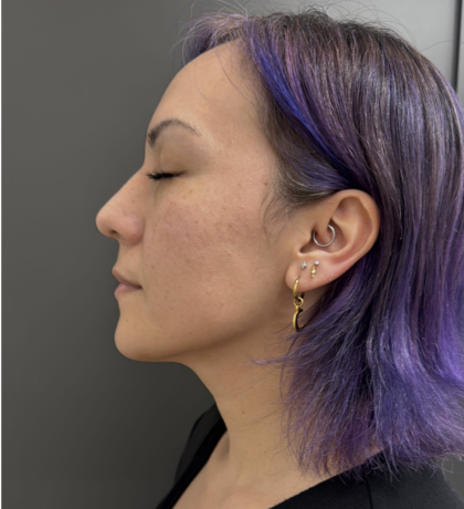 CO2 Laser Before & After Patient #17075