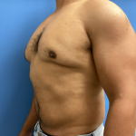 Liposuction Before & After Patient #17076