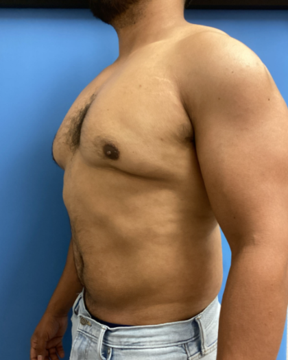 Liposuction Before & After Patient #17076