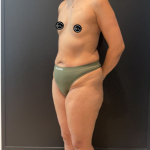 Mommy Makeover Before & After Patient #17077