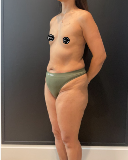 Mommy Makeover Before & After Patient #17077
