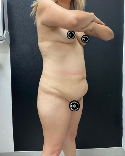 Mommy Makeover Before & After Patient #17079