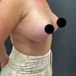 Breast Augmentation with Lift Before & After Patient #17073