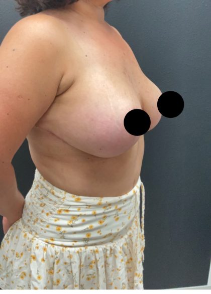 Breast Augmentation with Lift Before & After Patient #17073