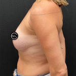 Breast Reduction Before & After Patient #17074