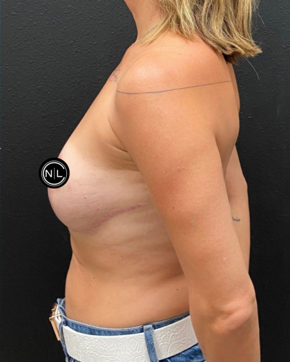 Breast Reduction Before & After Patient #17074