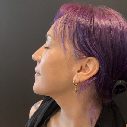 CO2 Laser Before & After Patient #17075