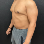 Liposuction Before & After Patient #17076