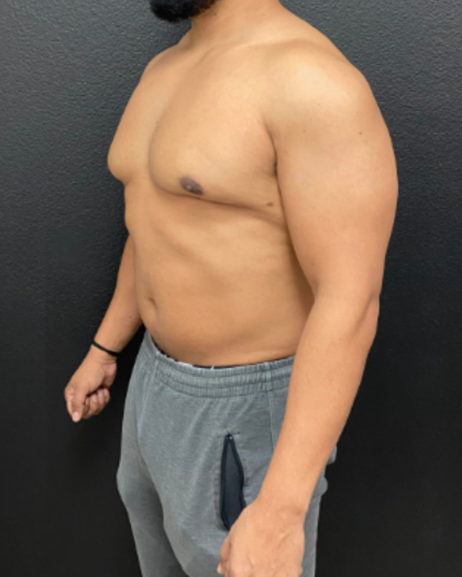 Liposuction Before & After Patient #17076