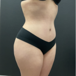 Mommy Makeover Before & After Patient #17079