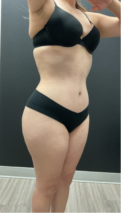 Mommy Makeover Before & After Patient #17079