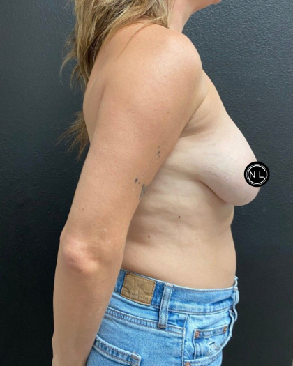 Breast Reduction Before & After Patient #17074