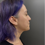 CO2 Laser Before & After Patient #17075