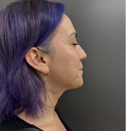 CO2 Laser Before & After Patient #17075
