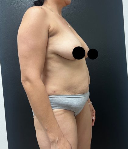 Mommy Makeover Before & After Patient #17078