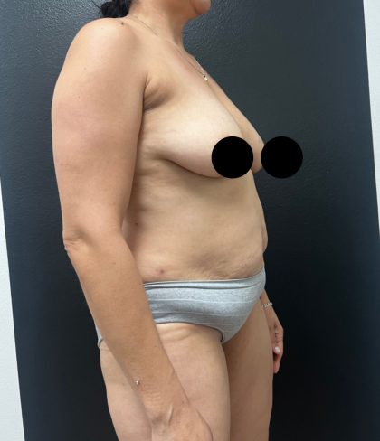 Mommy Makeover Before & After Patient #17078