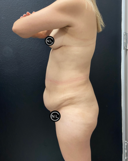 Mommy Makeover Before & After Patient #17079