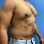 Liposuction Before & After Patient #17076