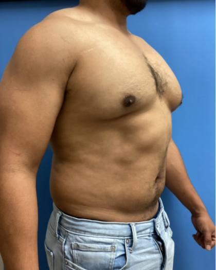 Liposuction Before & After Patient #17076