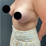 Breast Augmentation with Lift Before & After Patient #17073