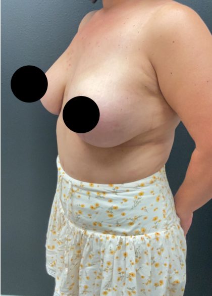 Breast Augmentation with Lift Before & After Patient #17073