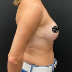 Breast Reduction Before & After Patient #17074