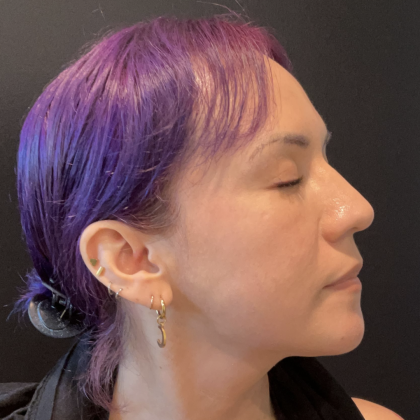 CO2 Laser Before & After Patient #17075