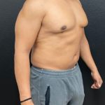 Liposuction Before & After Patient #17076