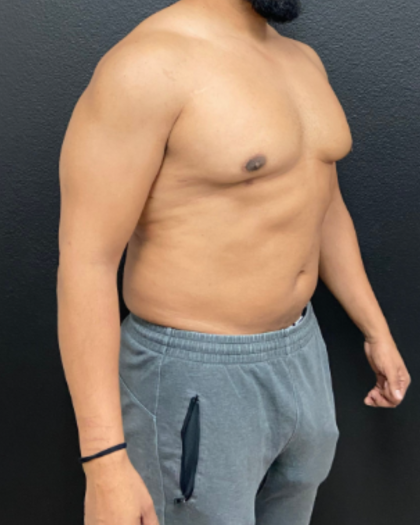 Liposuction Before & After Patient #17076