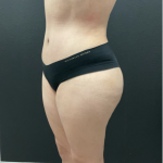 Mommy Makeover Before & After Patient #17079