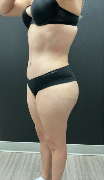 Mommy Makeover Before & After Patient #17079
