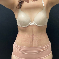 Abdominoplasty Before & After Patient #17072