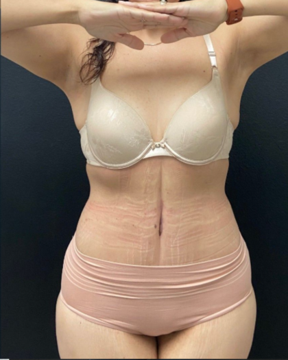 Abdominoplasty Before & After Patient #17072