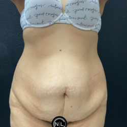 Abdominoplasty Before & After Patient #17072