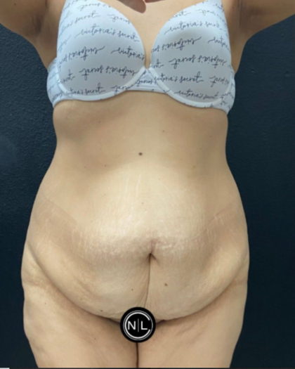 Abdominoplasty Before & After Patient #17072
