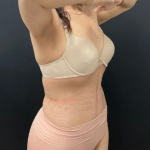 Abdominoplasty Before & After Patient #17072