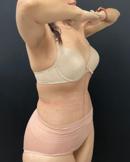 Abdominoplasty Before & After Patient #17072