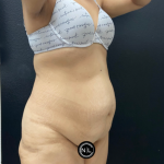 Abdominoplasty Before & After Patient #17072