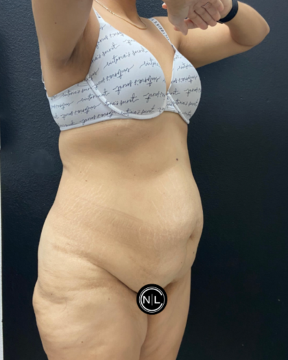 Abdominoplasty Before & After Patient #17072